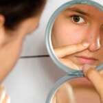 Remedios caseros para el acné